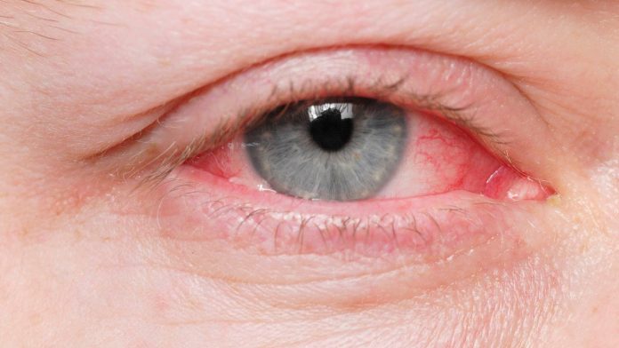 how do you get pink eye