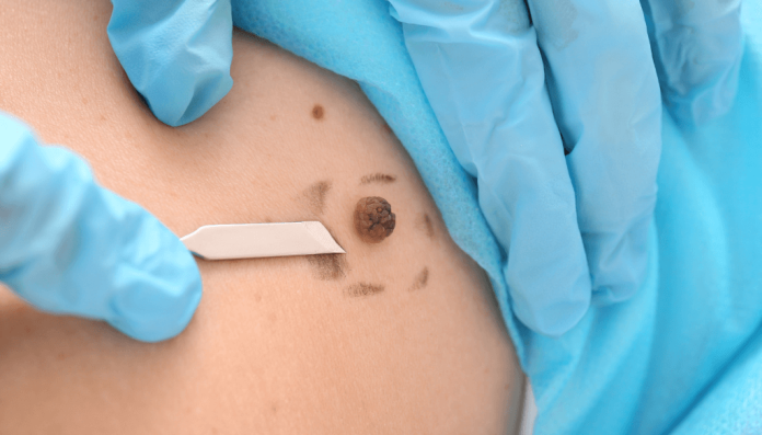 how to remove skin tags in one night