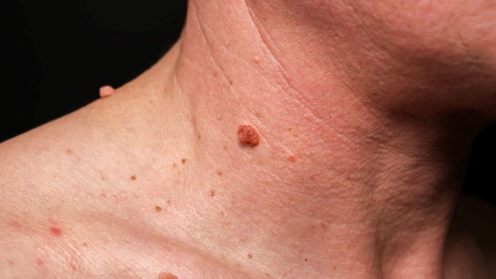 what is a skin tag